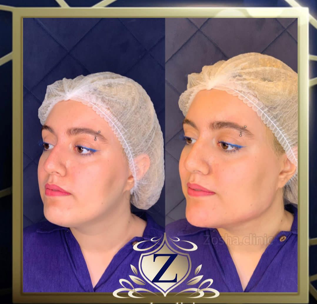 فرم دهی فک و چانه