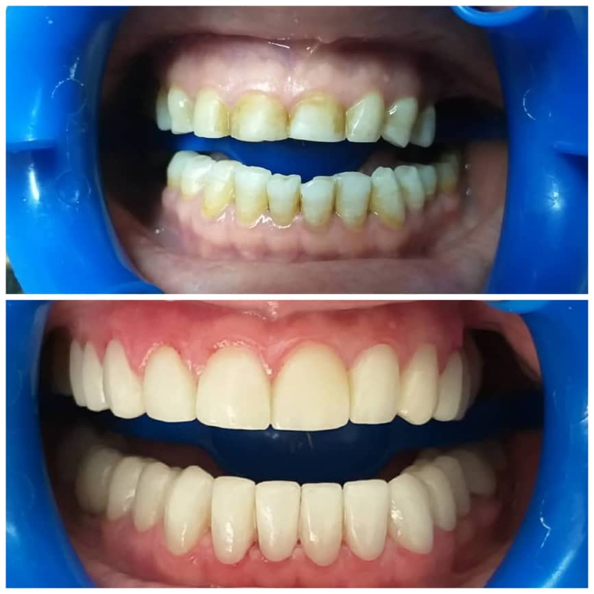 جراحی زیبایی لثه،افزایش ارتفاع دندانها،لمینیت(رنگ سرامیک به درخواست بیمار)
