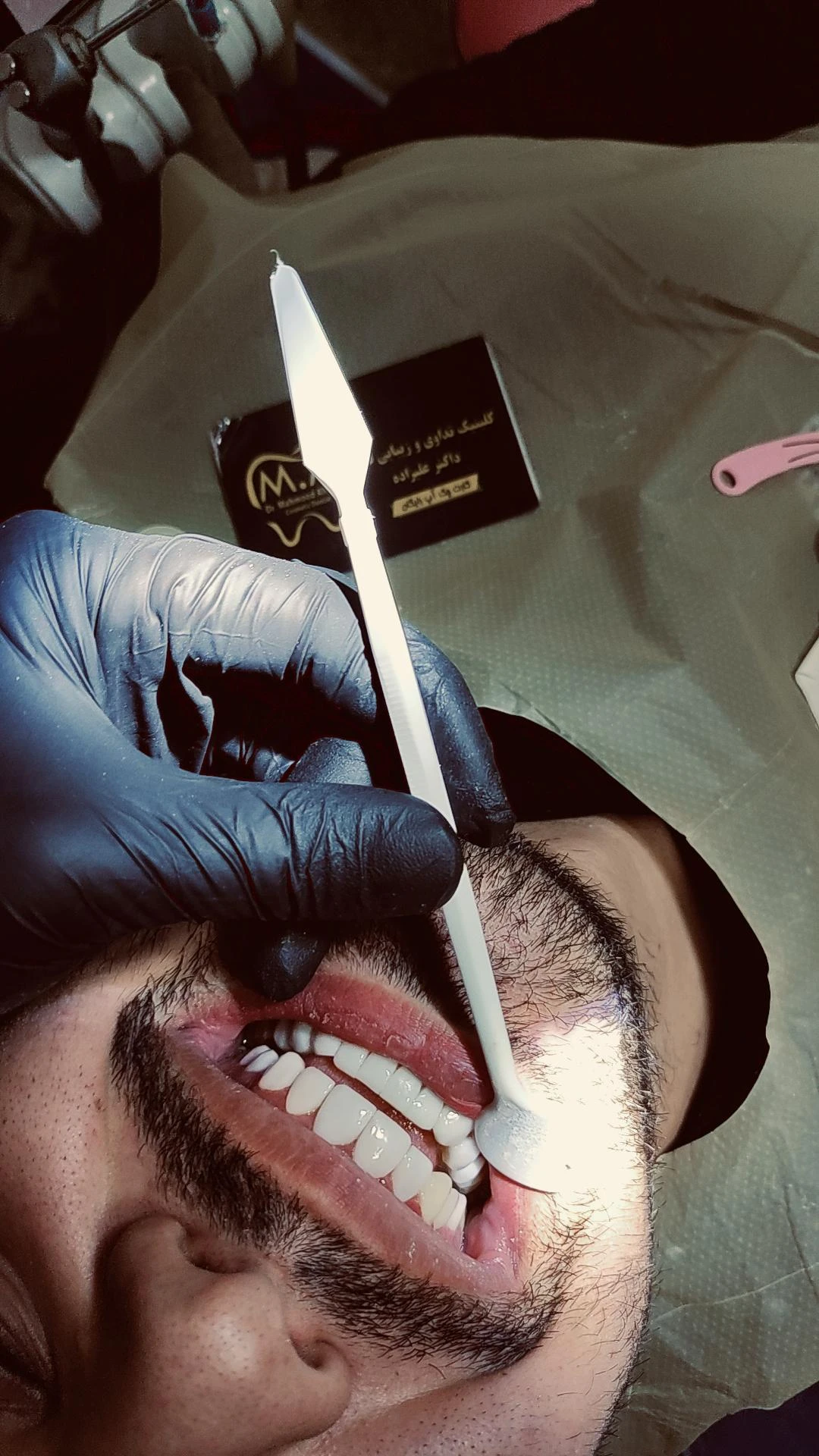Composite Veneer