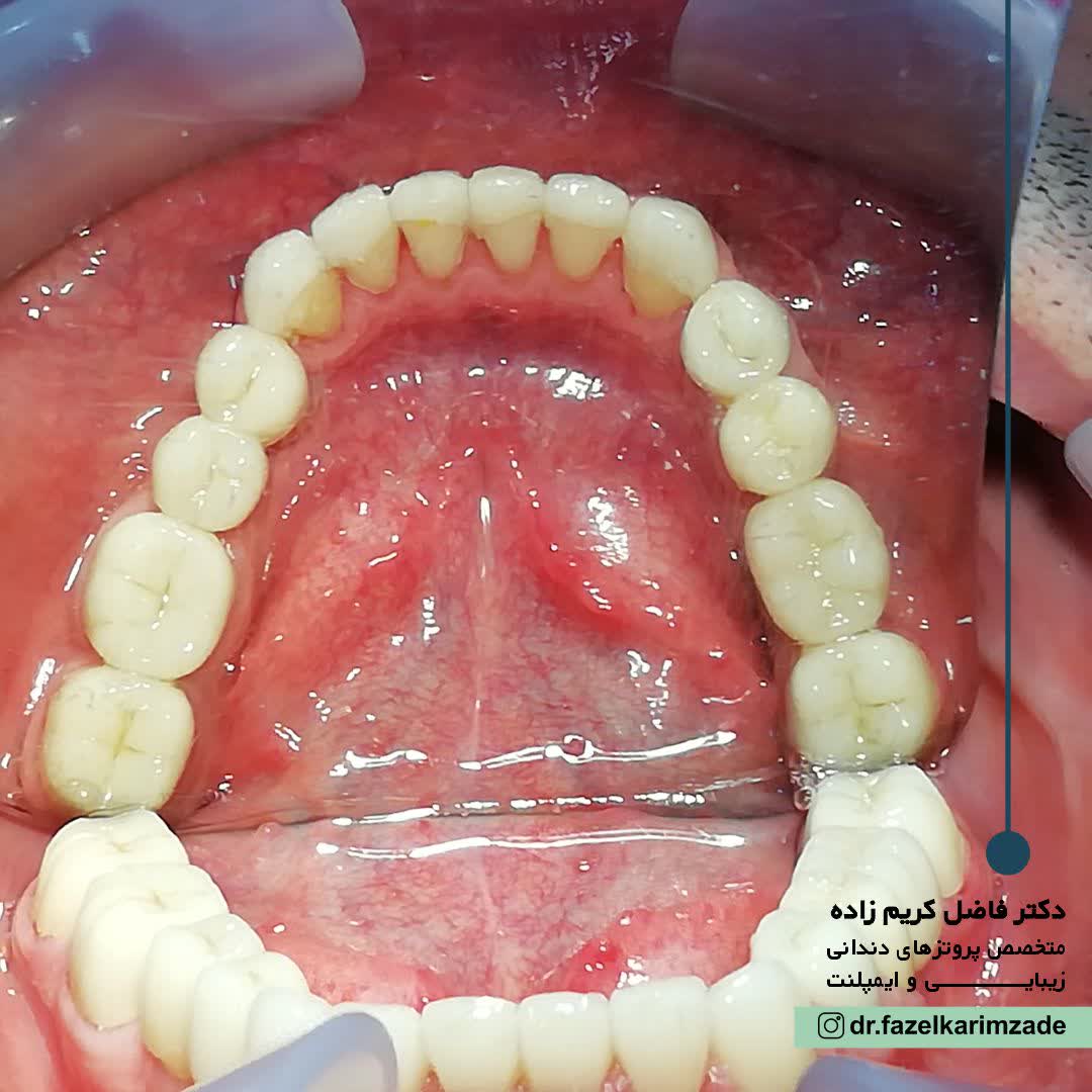 ایمپلنت ، لمینیت ، روکش سرامیکی 