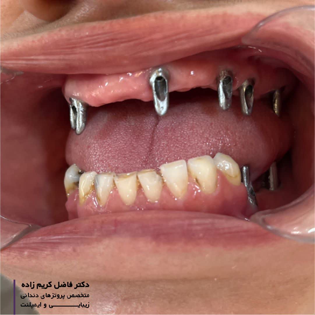 بازسازی لبخندی زیبا با ایمپلنت 