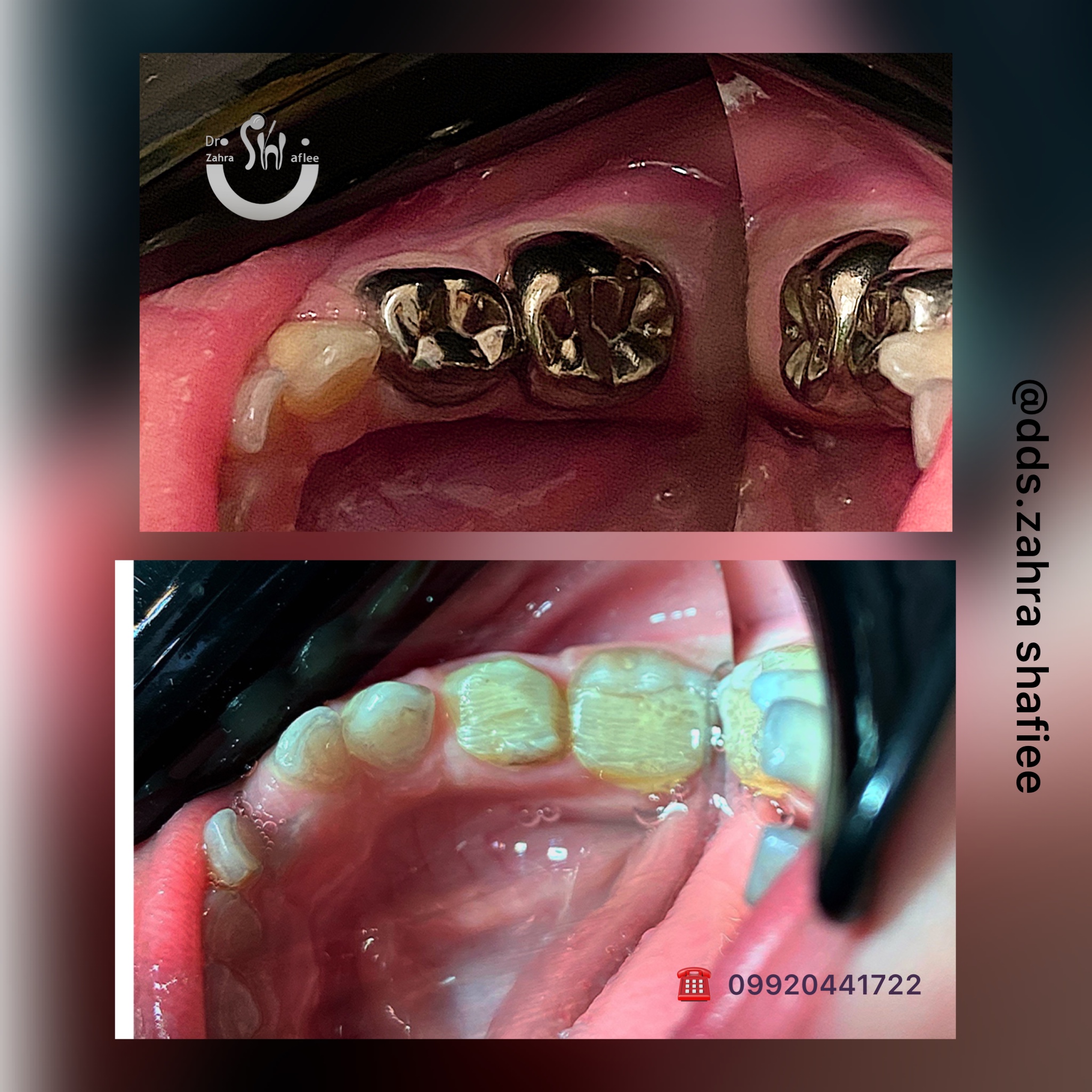 روكش اطفال